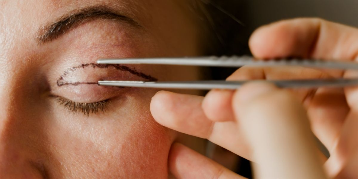 eyelid surgery