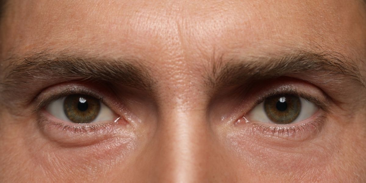 Male patient after brow lift for men in Northern Virginia showing improved brow position and reduced forehead heaviness